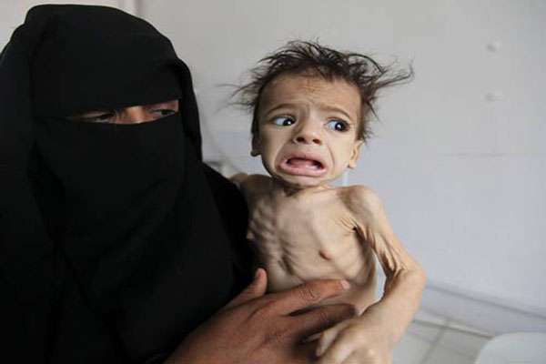 تقرير أممي: انقذوا 17 مليون يمني من الجوع