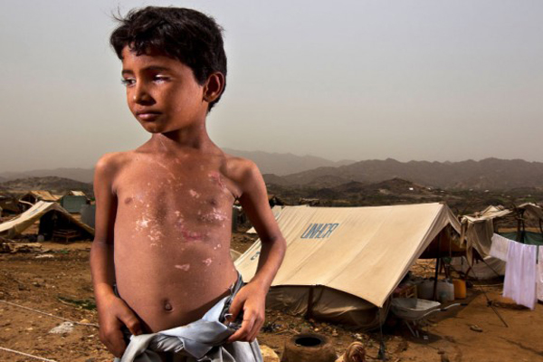 الأمم المتحدة تحذر من مخاطر الموت الجماعي في اليمن ودول أفريقية