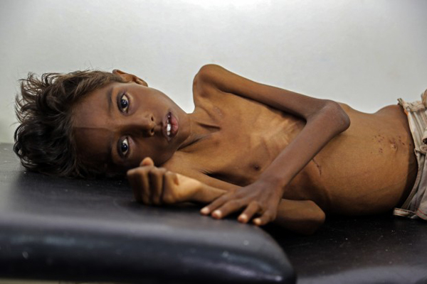 الجوع يدفع يمنيين إلى الانتحار