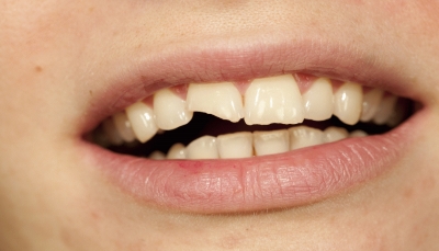 ماذا تقول "أسنانك" عن المخاطر الصحية التي تواجهك؟