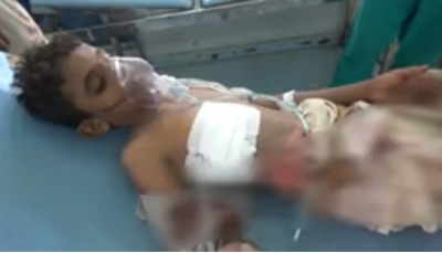 إصابة طفلين بجروح جراء انفجار مقذوف من مخلفات الحوثيين جنوبي الحديدة