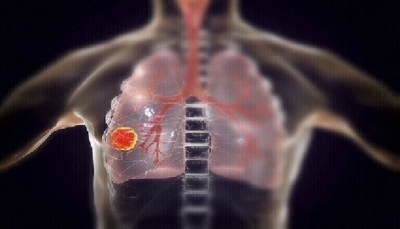 تعرف على خمس علامات تحذيرية "مفاجئة" لسرطان الرئة