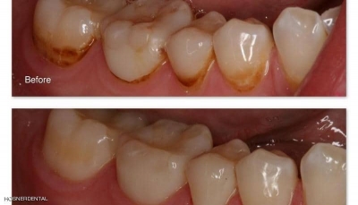 تعرف على طريقة للتخلص من البقع البنية في الأسنان