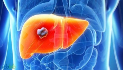 الكشف عن أعراض أخرى غير متوقعة لتليّف "الكبد"