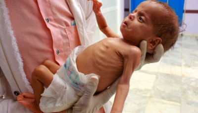 فوربس: أكثر من مليوني طفل دون الخامسة يواجهون خطر الموت في اليمن