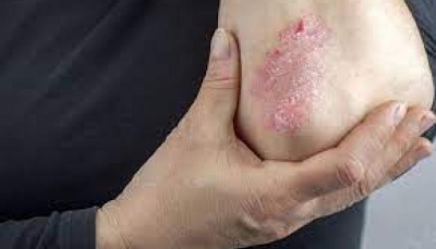 تعرف على 6 علامات على الجلد تشير للإصابة بالسكري