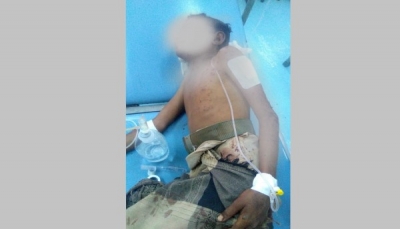 إصابة طفل بانفجار لغم زرعه الحوثيون أثناء رعيه للماشية غرب تعز