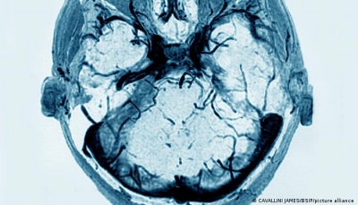 ماهي عوامل الخطر للإصابة بالسكتة الدماغية؟