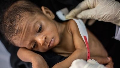 بريطانيا: نصف الأطفال في اليمن يعانون من التقزم بسبب سوء التغذية