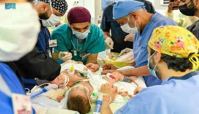 فريق طبي سعودي يبدأ عملية فصل التوأم السيامي اليمني 