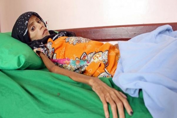 فتاة بعمر 12عام تعاني سوء التغذية وصل وزنها 10 كيلو تلخص تأثير الحرب في اليمن
