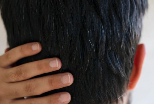 كيف يؤثر "القلق والتوتر" على تساقط شعر رأسك؟
