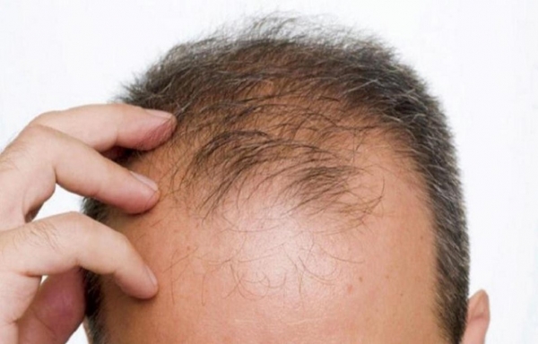 خبراء يكشفون 5 أسباب "مفاجئة" تجعل الشعر يتساقط