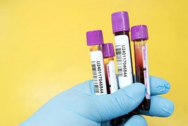 باحثون أمريكيون يطورن اختبار مرض "القلق" عبر فحص الدم